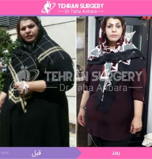 عکس قبل و بعد جراحی لاغری