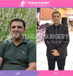 عکس قبل و بعد جراحی لاغری