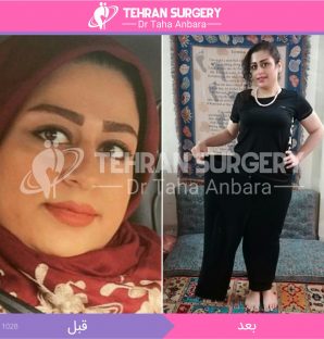 عکس قبل و بعد جراحی لاغری