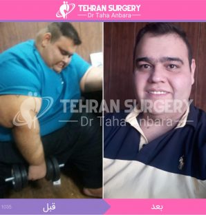 عکس قبل و بعد جراحی لاغری