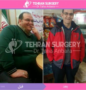 عکس قبل و بعد جراحی لاغری