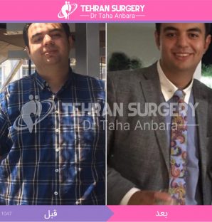 عکس قبل و بعد جراحی لاغری