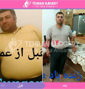 عکس قبل و بعد جراحی لاغری