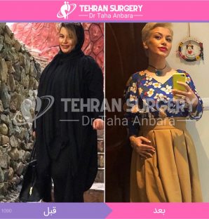 عکس قبل و بعد جراحی لاغری