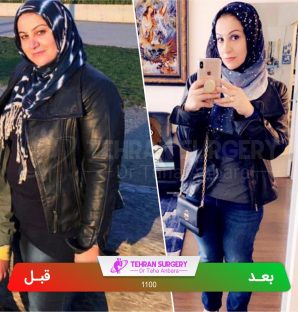 عکس قبل و بعد جراحی لاغری