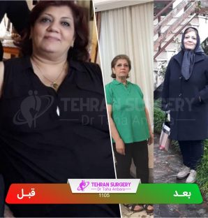 عکس قبل و بعد جراحی لاغری