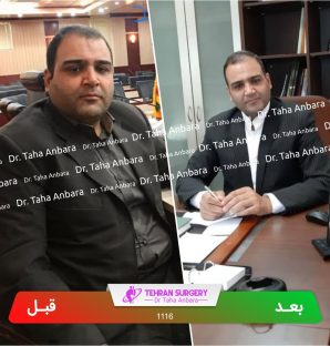 عکس قبل و بعد جراحی لاغری