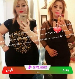 عکس قبل و بعد جراحی لاغری