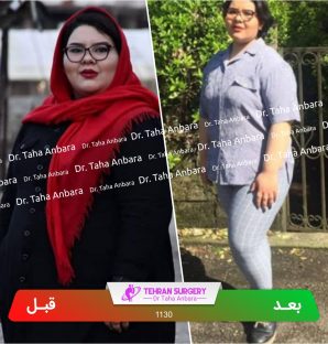 عکس قبل و بعد جراحی لاغری