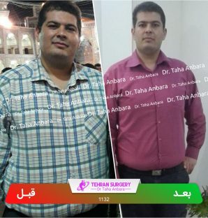 عکس قبل و بعد جراحی لاغری