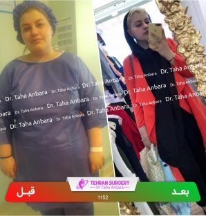 عکس قبل و بعد جراحی لاغری