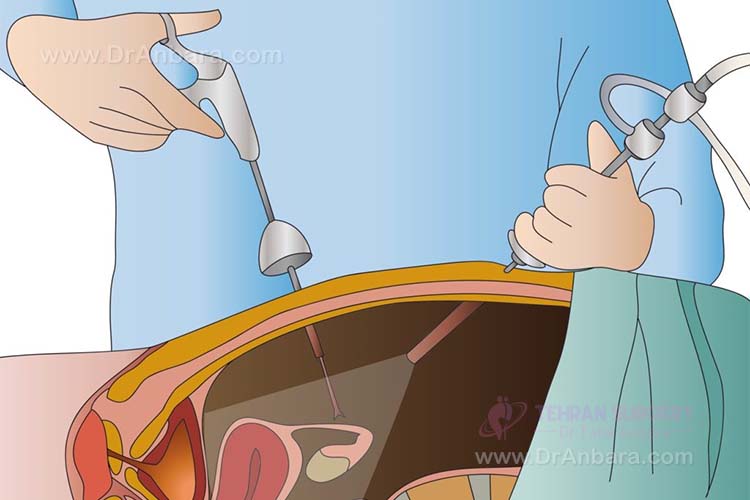 جراحی لاپاراسکوپی چیست؟ همه چیز درمورد جراحی لاپاراسکوپی جراحی لاپاراسکوپی چیست؟ همه چیز درمورد جراحی لاپاراسکوپی