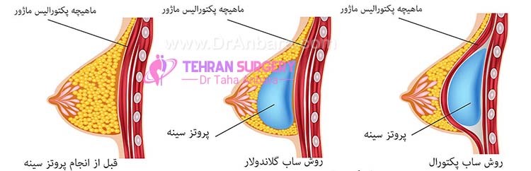 جاگذاری پروتز سینه