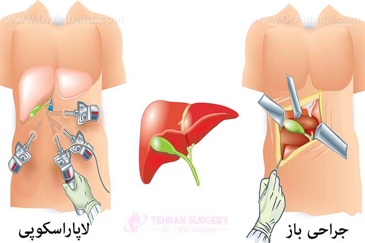 جراحی لاپاراسکوپی در مقایسه با جراحی باز