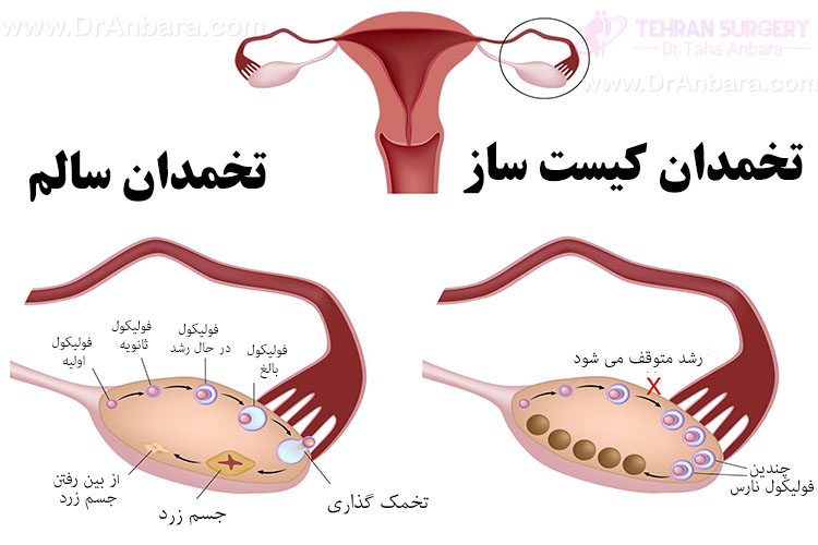 اینفوگرافیک درمان خانگی کیست تخمدان