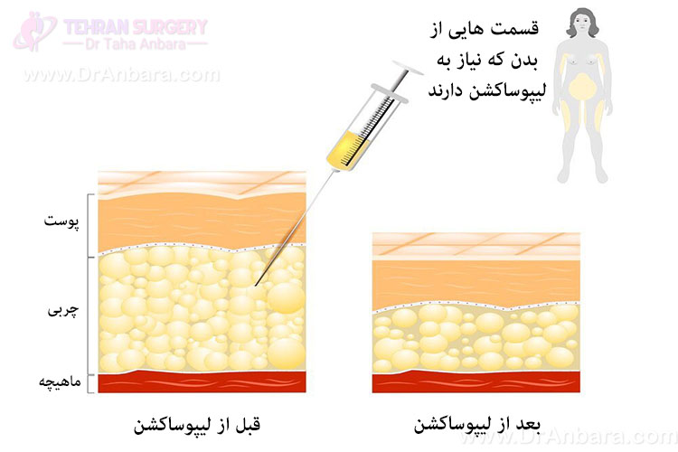 تصویر چربی های بدن قبل و بعد از جراحی لیپوساکشن