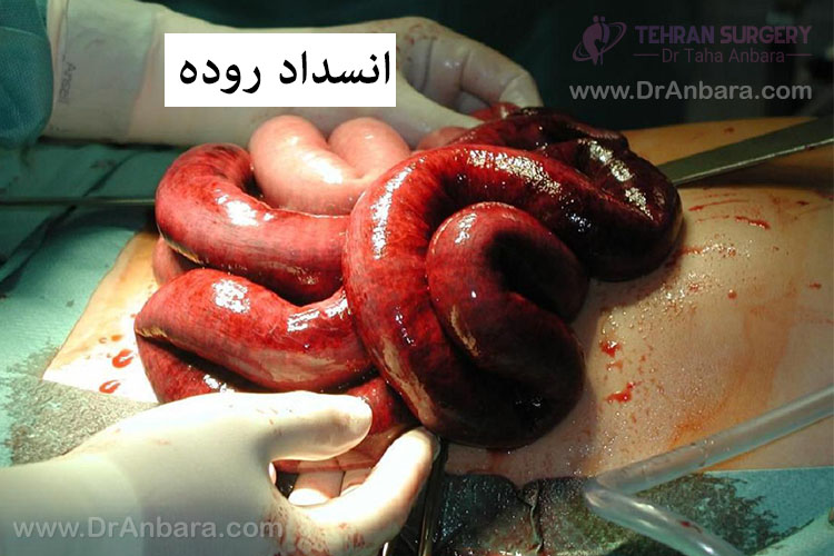 انسداد روده
