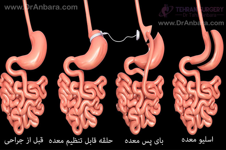 انواع جراحی های لاغری