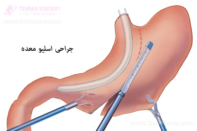 تصویر جراحی اسلیو معده