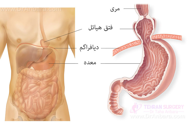 فتق هیاتل بعد از جراحی اسلیو معده