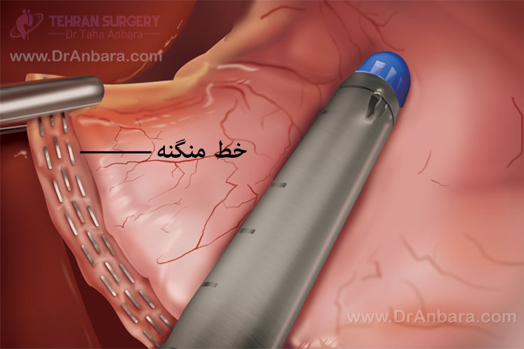 خط منگنه در جراحی اسلیو معده