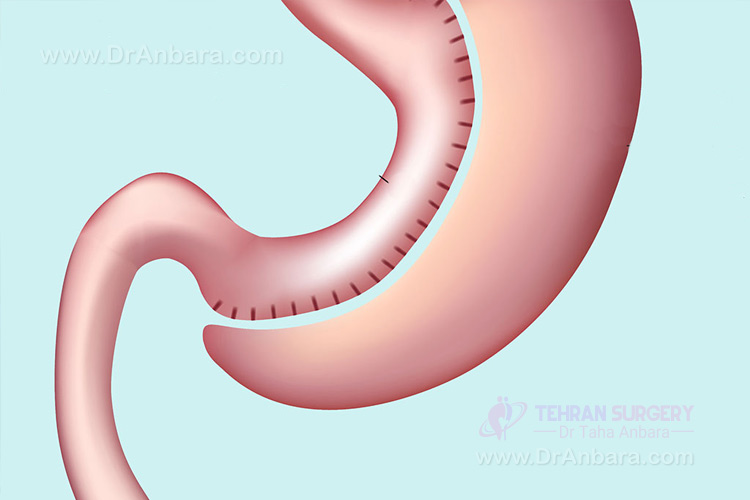 مراحل اسلیو معده