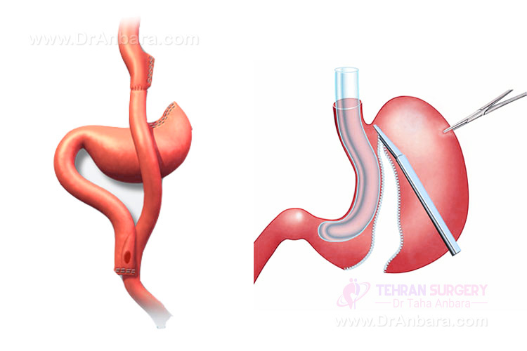 مراحل جراحی بای پس معده