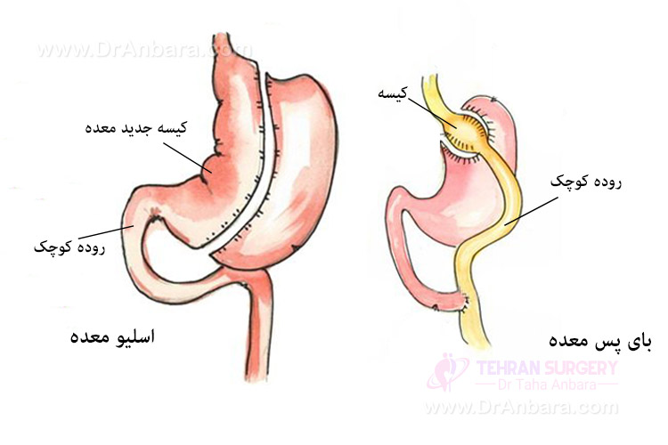 تفاوت اسلیو معده و بای پس معده