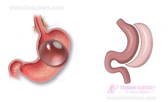 بالون معده یا اسلیو معده؟ کدام بهتر است؟