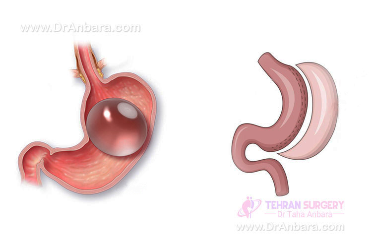 بالون معده یا اسلیو معده؟ کدام بهتر است؟