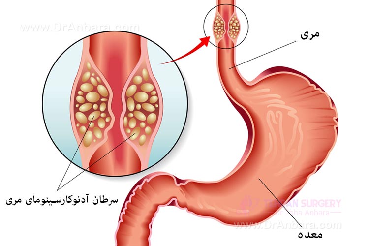 سرطان آدنوکارسینومای مری