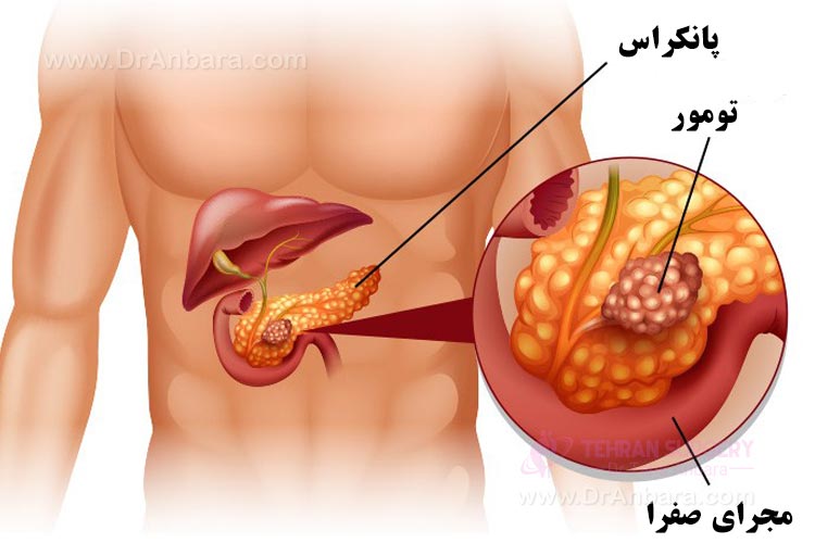 سرطان پانکراس