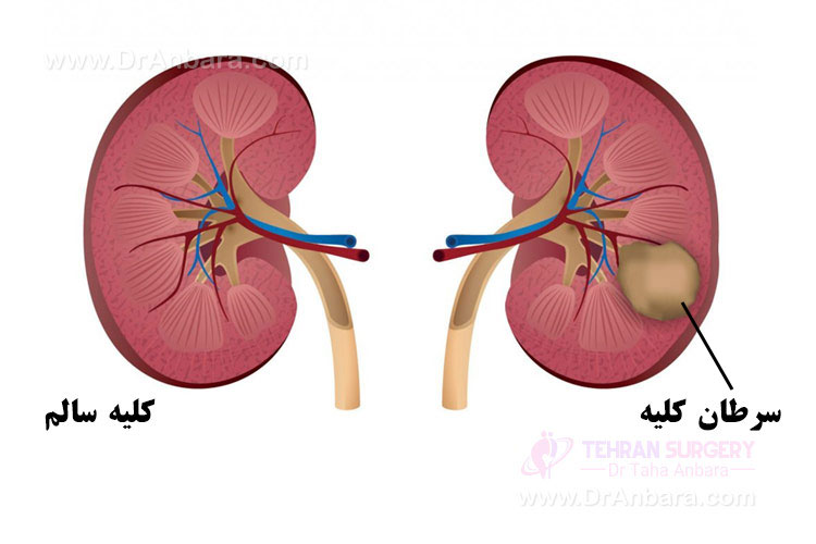 مقایسه کلیه سالم و کلیه سرطانی