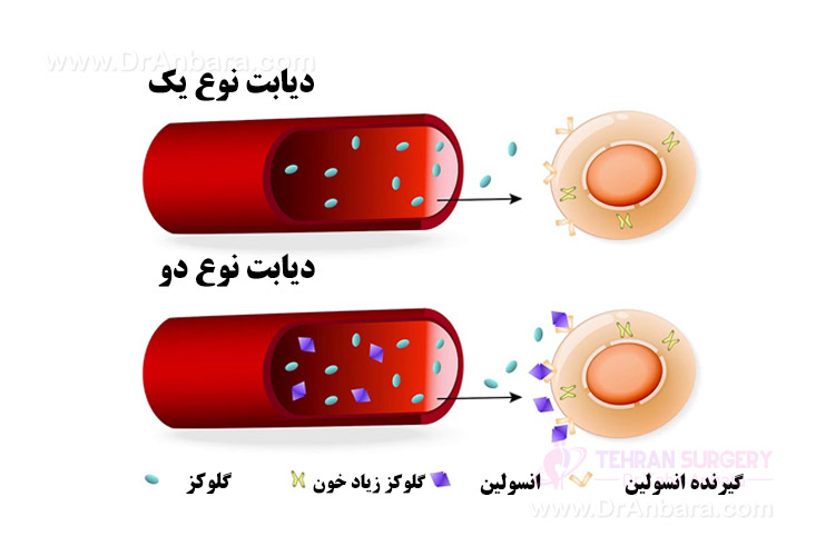 انواع دیابت