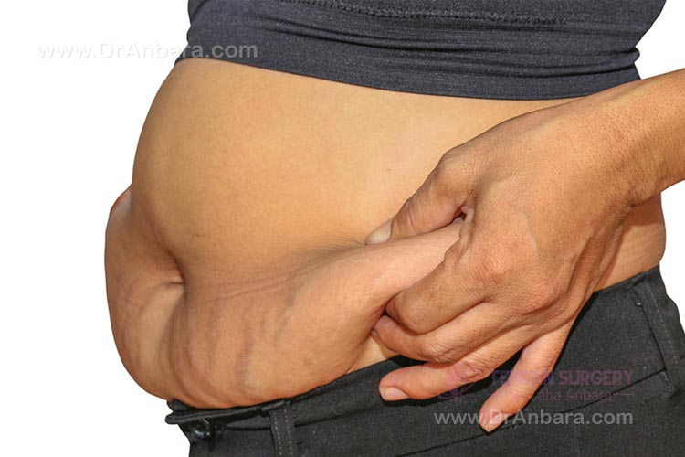 افتادگی پوست بعد از جراحی لاغری افتادگی پوست بعد از جراحی لاغری