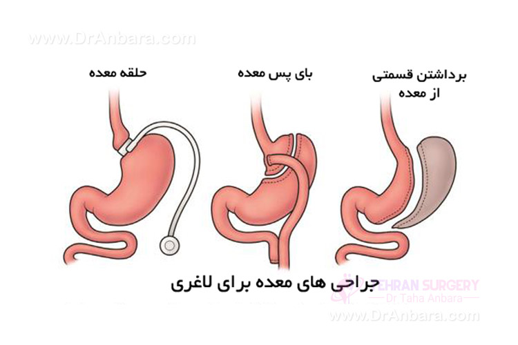 انواع روش های جراحی لاغری