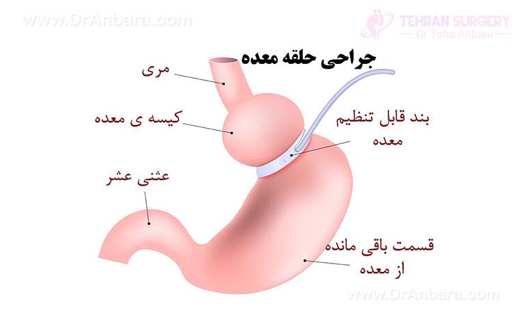 جراحی حلقه معده