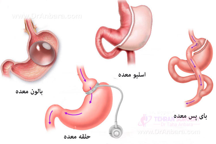 کدام نوع جراحی لاغری برای من مناسب است؟