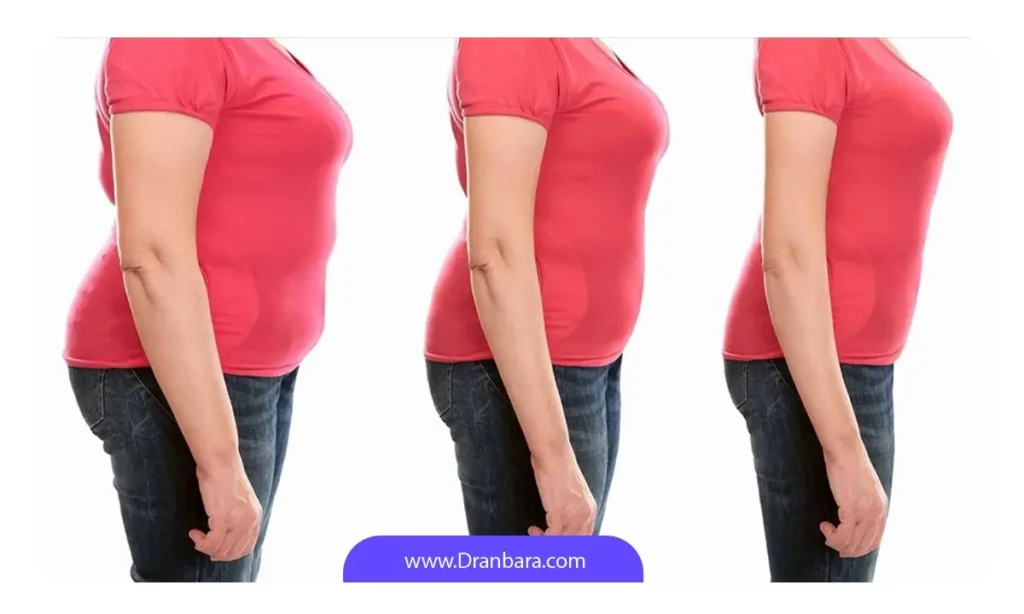 از مزایای بالون معده کاهش وزن سریع است