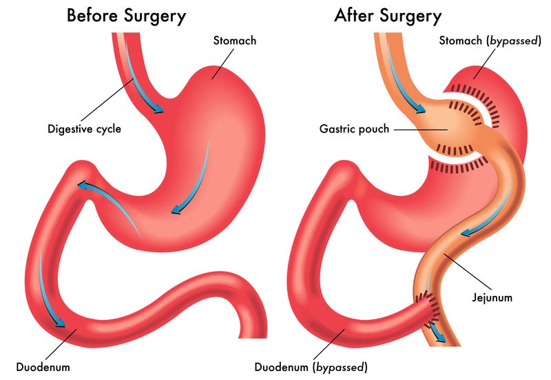 gastric bypass surgery - Dr. Taha Anbara Bariatric surgeon