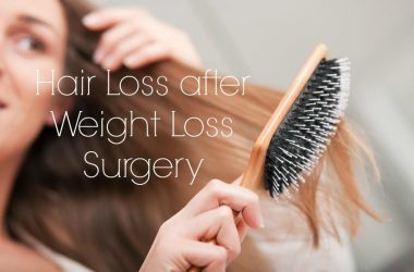 How To Prevent Hair Loss After Surgery Archives جراح لاغری