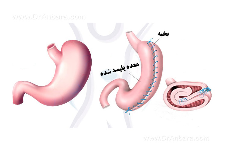 جراحی پلیسه معده