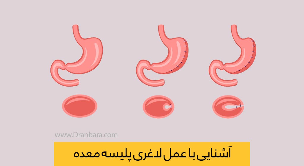 عکس عمل جراحی لاغری پلیسه معده