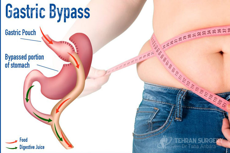 Gastric bypass risks and complications Gastric bypass risks and complications