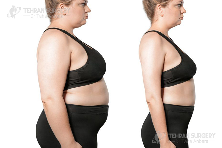 Weight loss surgery stories Weight loss surgery stories