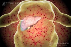 Obesity and fatty liver disease