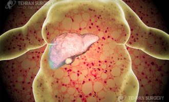 Obesity and fatty liver disease