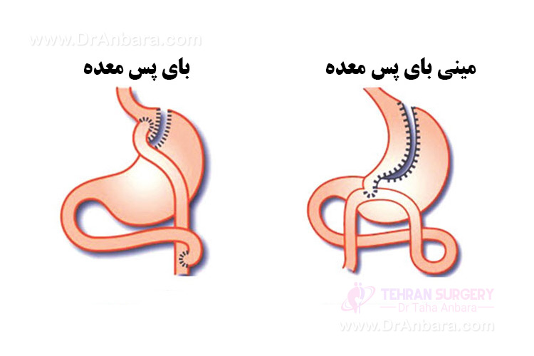 کاهش وزن با مینی بای پس