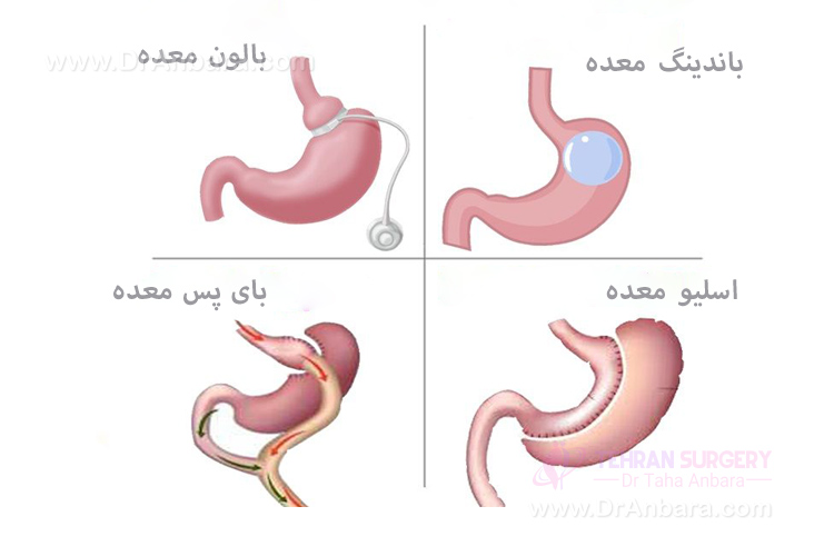 عمل لاغری و فشار خون