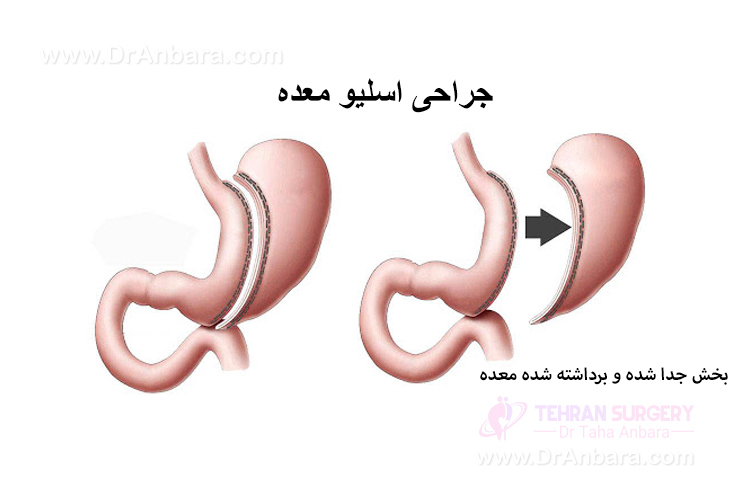 عمل جراحی اسلیو معده